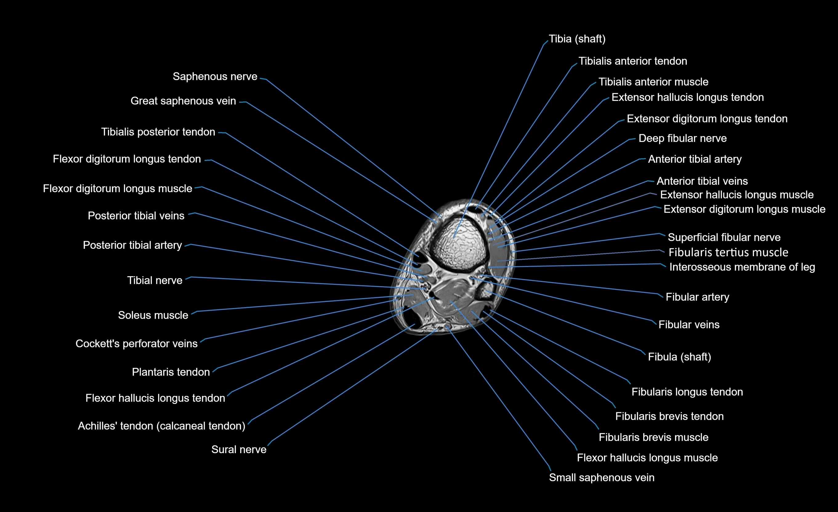 MRI lower leg axial cross sectional anatomy 3T  radiology  image-img-00001-00092.webp
